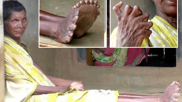Người phụ nữ có 19 ngón chân, 12 ngón tay bị kỳ thị là "phù thủy"