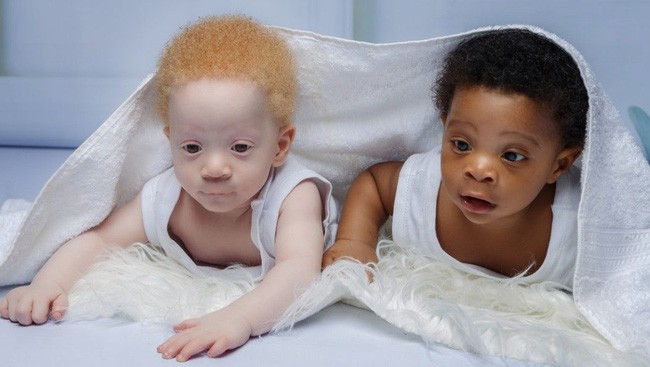 Hai đứa trẻ song sinh nhưng ngoại hình lại hoàn toàn trái ngược nhau.