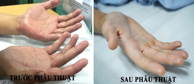 Bàn tay trước và sau phẫu thuật. (BVCC).
