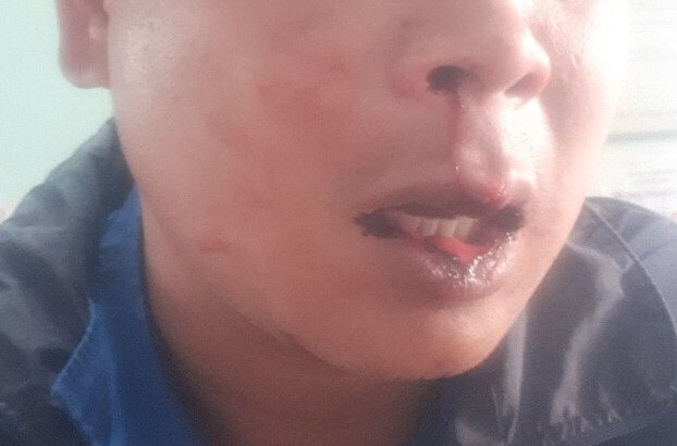 Anh Dương bị hành khách đánh dập cả mồm miệng.