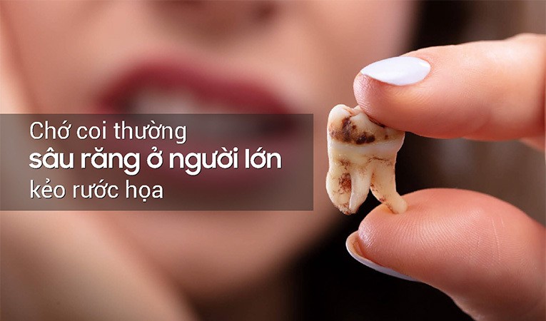 Sâu răng ở người lớn có thể dẫn đến những hậu quả nghiêm trọng