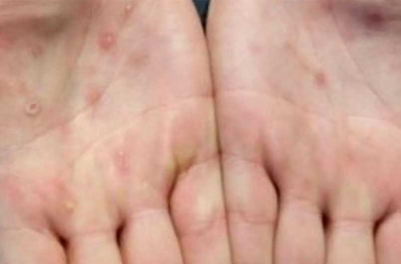Bệnh đậu mùa khỉ thường biểu hiện rõ nhất ở lòng bàn tay. (Ảnh: ITN)