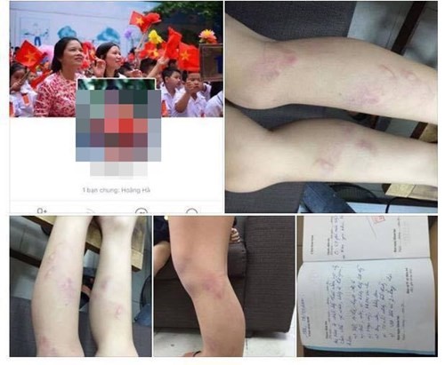 Học sinh M.Đ bị đánh tím chân và sổ khám tại bệnh viện (ảnh chụp màn hình)