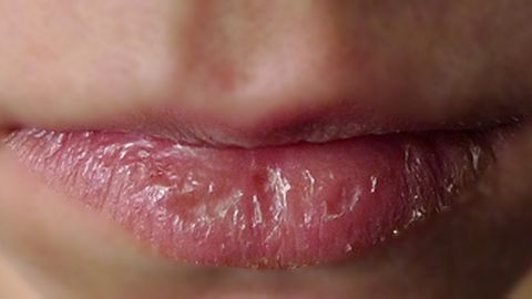 Cách giúp đôi môi nứt nẻ trở nên mịn màng