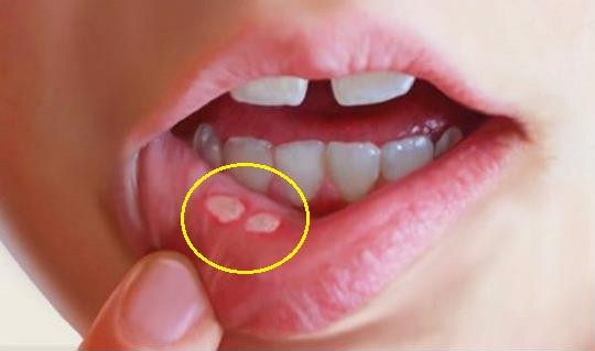 Mọc mụn thịt trong miệng là dấu hiệu của nhiều loại bệnh khác nhau