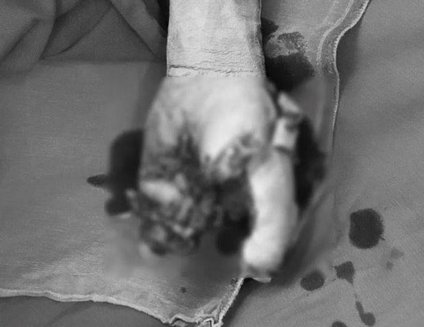 Bàn tay của bệnh nhân bị dập nát do điện thoại phát nổ. (Ảnh: PV/Vietnam+).