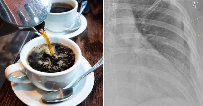 Uống 10 tách cà phê mỗi ngày, đi khám bác sĩ sửng sốt khi nhìn kết quả X-quang 