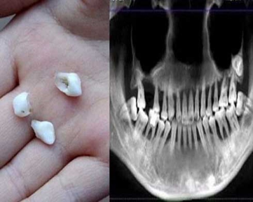 Thói quen xấu khiến cô gái 28 tuổi rụng hết hai hàm răng đau đớn