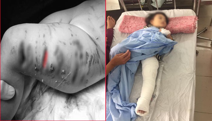 Hà Nội: Mẹ hãi hùng thấy con gái 2 tuổi bị chó Pitbull tấn công