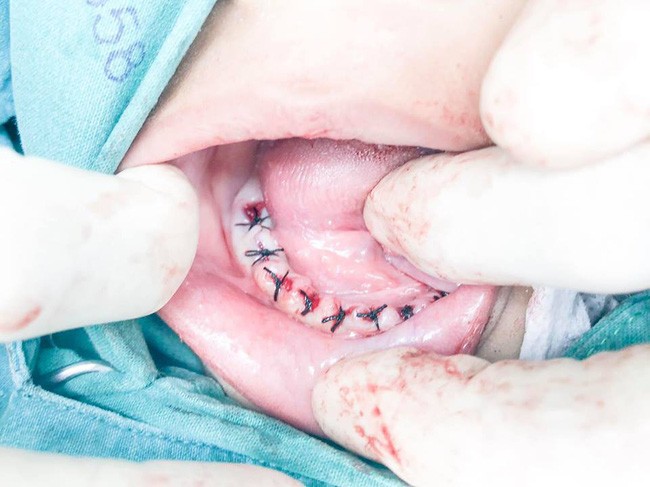 Lặp đi lặp lại thói quen tai hại này, bố mẹ khiến con 4 tuổi mất toàn bộ 18 chiếc răng