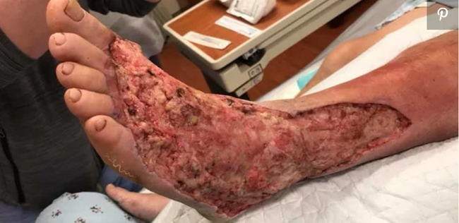 Người đàn ông đang mất dần đôi chân do vi khuẩn ăn thịt người