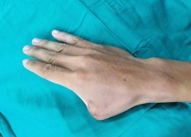 Lấy ngón chân tạo thành ngón tay cái cho bệnh nhân