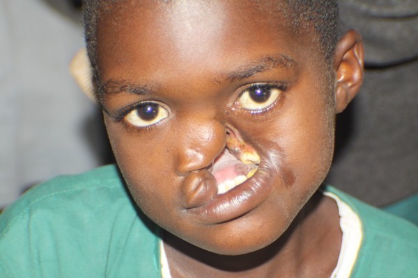Noma - Căn bệnh kinh hoàng nhất thế giới, chỉ có 15% trẻ em sống sót 
