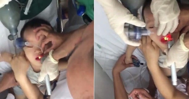 Video: Căng não theo dõi 15 phút cứu bé trai đã ngưng tim, ngưng thở vì hóc thạch rau câu