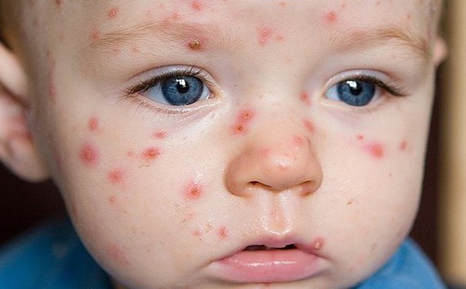 3 dấu hiệu phân biệt bệnh sởi và sốt phát ban 