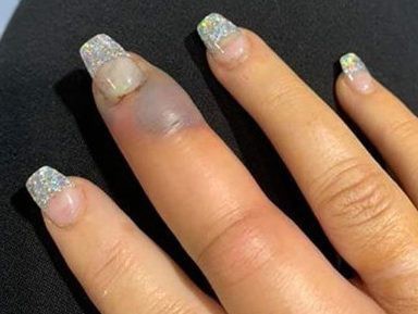 Sau vài tuần đi làm nail, cô gái nhận thấy ngón tay có điều gì đó không ổn.