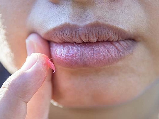 Bà Tracy French mắc ung thư biểu mô tế bào vảy trên môi, một trong những loại ung thư da phổ biến nhất
Ảnh minh họa: Shutterstock.