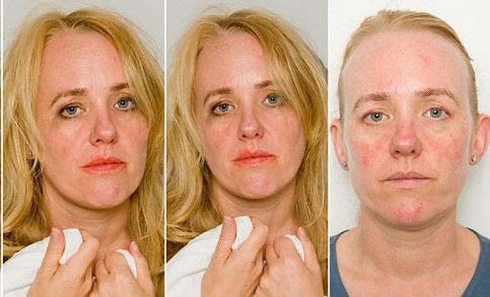 Bạn có thể thấy rõ sự xuống cấp của làn da trên khuôn mặt một tình nguyện viên bị yêu cầu chỉ "tẩy trang" bằng nước trong vòng 1 tháng.
