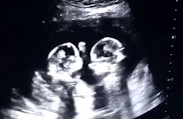 Hai em bé nằm chung một bọc ối, chung nhau thai.