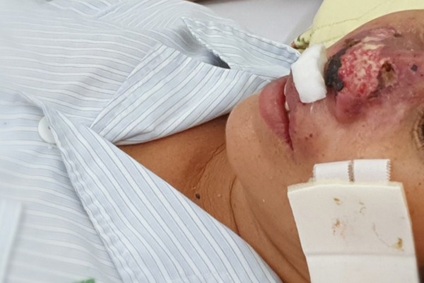 Nữ bệnh nhân quê ở Thanh Hoá bị whitmore ăn cụt cánh mũi. Đây là trường hợp bệnh nhân nữ đầu tiên mắc whitmore.
