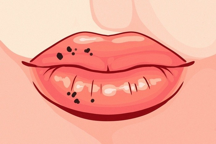 Đốm đen trên môi là dấu hiệu tiền ung thư hoặc cho thấy cơ thể hấp thụ quá nhiều chất sắt từ thực phẩm bạn ăn.