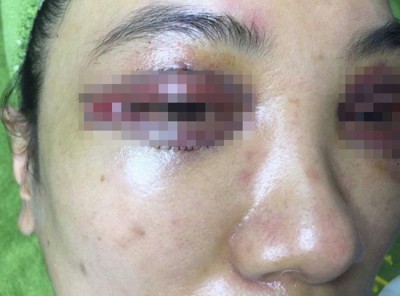 Bệnh nhân gặp sự cố nghiêm trọng sau phẫu thuật thẩm mỹ vùng mắt.