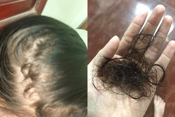 Yen Vu từng gặp khó khăn khi tóc rụng không kiểm soát đến mức hói đầu.