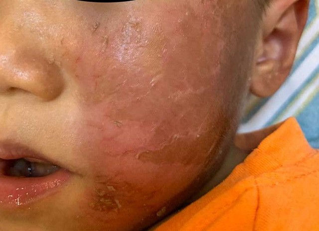 Phần da mặt của bé trai bị đỏ ngứa, bỏng rộp.