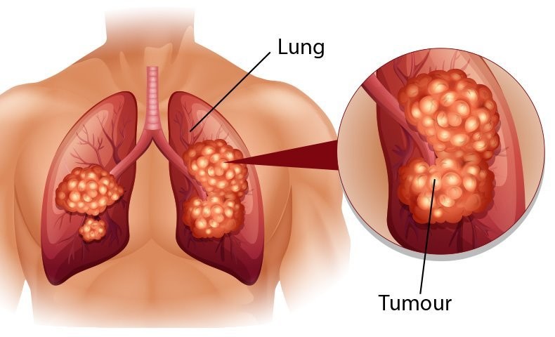 Nguyên nhân dẫn đến bệnh ung thư phổi chưa rõ ràng song người ta tìm thấy mối liên hệ giữa một số yếu tố với bệnh lý ác tính này.