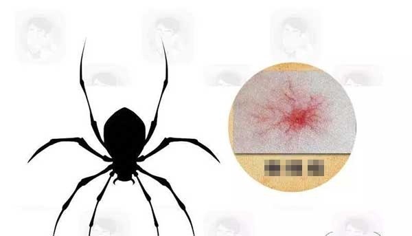 Y học chỉ ra rằng, sự hình thành của đốm nhện có liên quan trực tiếp đến rối loạn chức năng gan. 