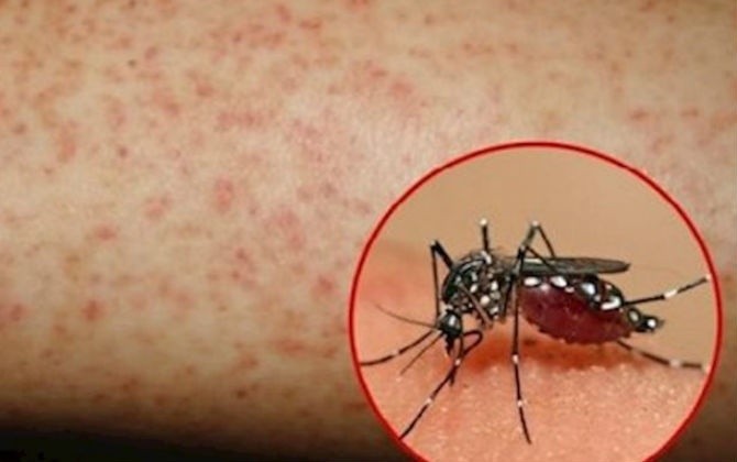 Sốt xuất huyết lây truyền chủ yếu do muỗi Aedes Aegypti.
