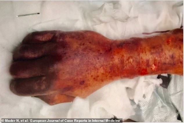 Tình trạng hoại tử (một khối lượng đáng kể các mô cơ thể chết) xảy ra ở tay và chân của người đàn ông.