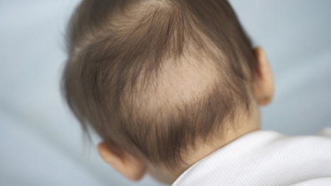 Rụng tóc ở trẻ sơ sinh là một phần tự nhiên trong sự tăng trưởng và phát triển của em bé (Ảnh minh họa).