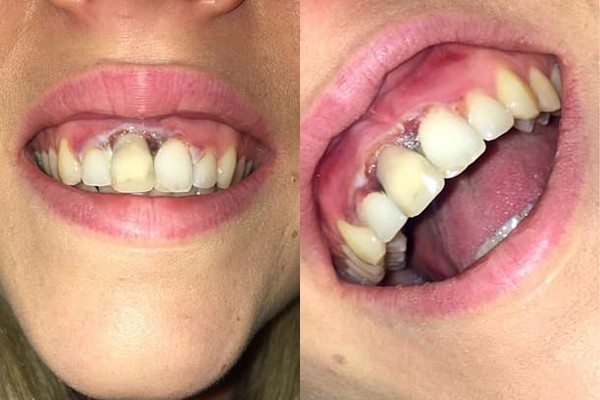 Phần lợi xung quanh 4 răng cửa của Wills chuyển sang màu đen và đau đớn sau khi tẩy trắng răng.