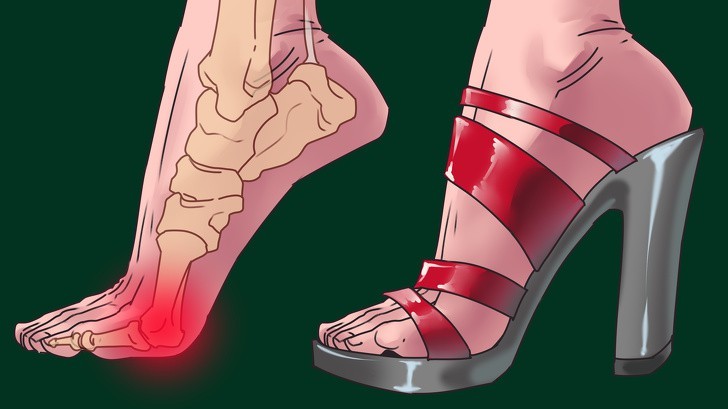 Các dây thần kinh ở bàn chân bị chèn ép, dồn nén sẽ bị dày lên và gây đau đớn. Bạn cũng có thể bị đau, cứng và sưng ở cả phần gót chân.