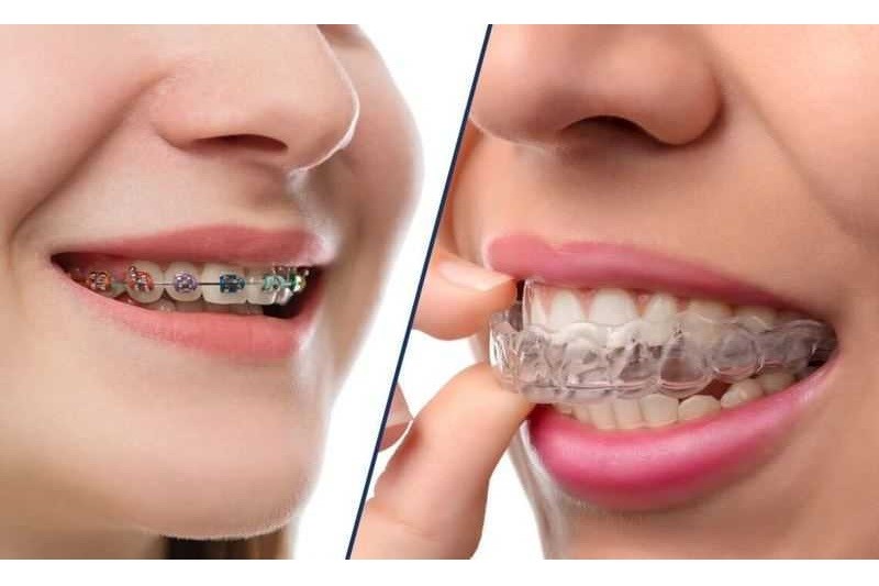 Niềng răng giúp mỗi người có nụ cười đẹp hơn nhưng là phương pháp thẩm mỹ nha khoa không phải ai cũng có thể áp dụng.