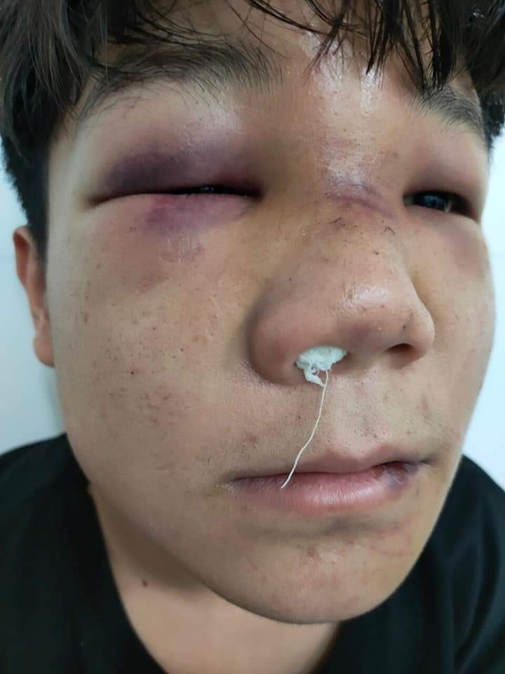 Học sinh Lưu Việt Thịnh (trường Trung cấp Dân tộc nội trú tỉnh Thái Nguyên) bị hành hung 